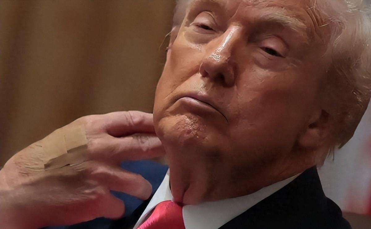 特朗普的那些事儿，身体，霸权，还有欧洲的那些糟心玩意儿，最近他手上有淤青了，挺吓