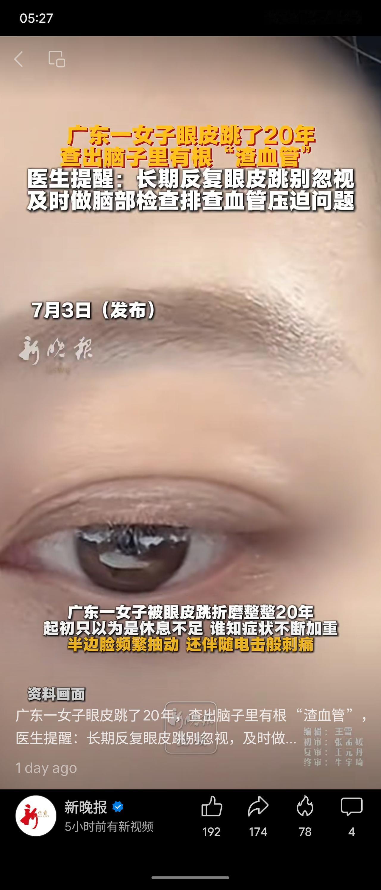 广东一女子眼皮跳长达20年，误以为休息不足，实则颅内血管长期压迫面神经与三叉神经