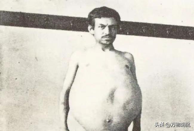 “他是被屎憋死的。”1940年，美国人约翰由于便秘，三年没排泄，不幸去世，医生检