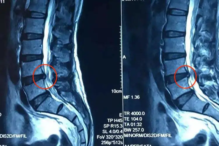 女性腰椎间盘突出图片