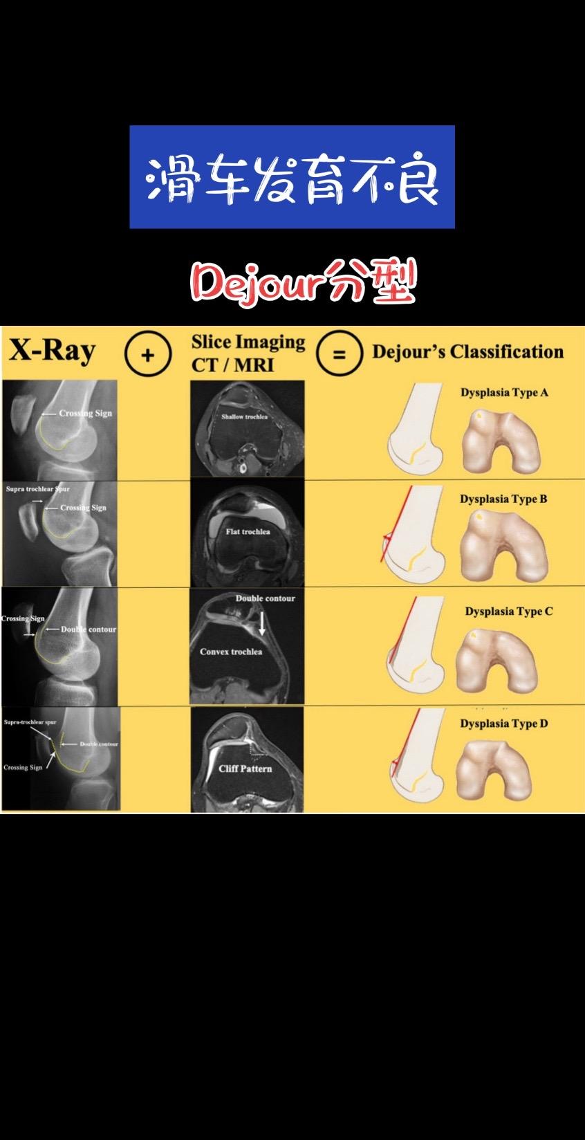 滑车发育不良Dejour分型。髌骨不稳的治疗需重点关注骨性解剖异常，其...