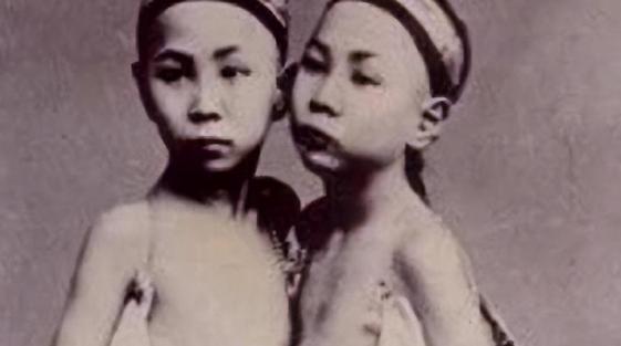 中国的连体兄弟，却在美国发了财，娶了一对洋姐妹，生了22个孩子。
 
在十九世纪