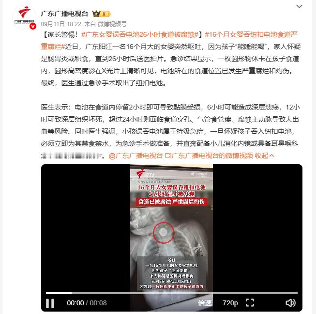 16个月女婴吞纽扣电池食道严重腐烂16个月大的女婴突然出现呕吐症状，家人看她还能