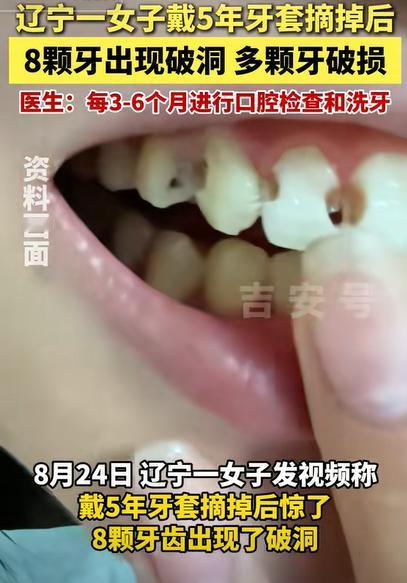 “最担心的事还是发生了！”辽宁一女子把戴了5年的牙套摘掉后，发现有8颗牙齿出现破