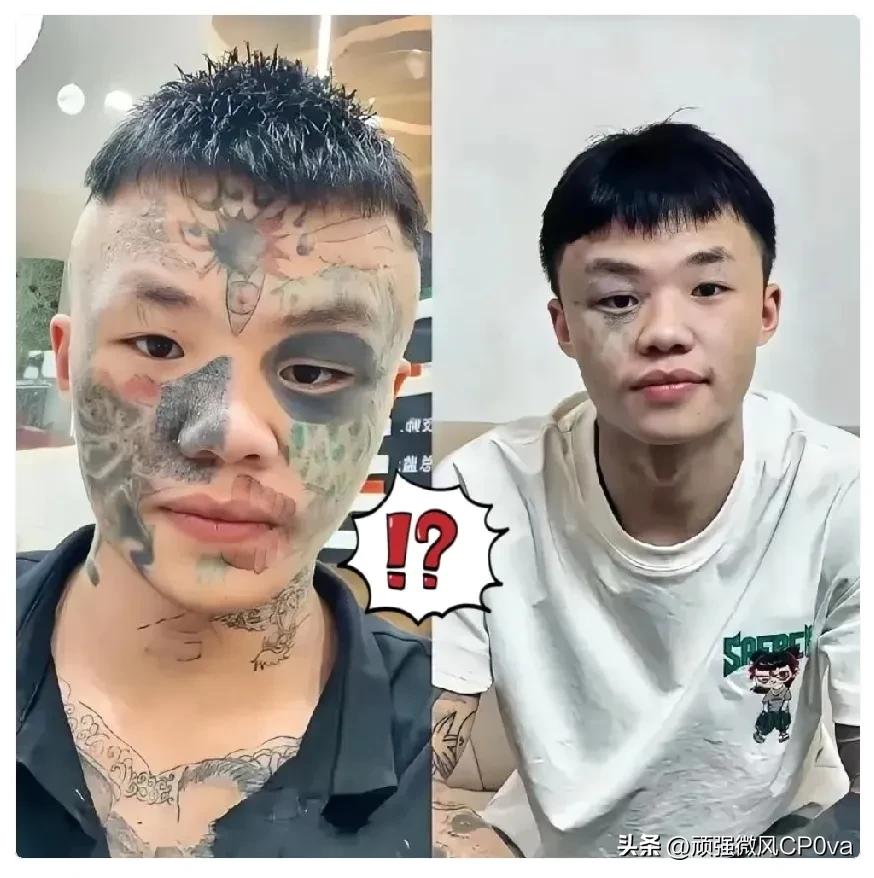 广东，纹面男孩夏朝勇为了洗掉年少时的纹身，已经做了三次激光清洗，再洗两次就能完全