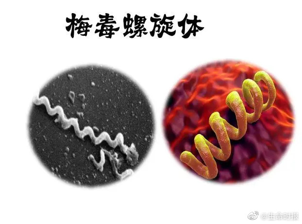 【#什么是神经梅毒#】 #神经梅毒或致性格改变# 江苏南京，60岁的陆先生半年前