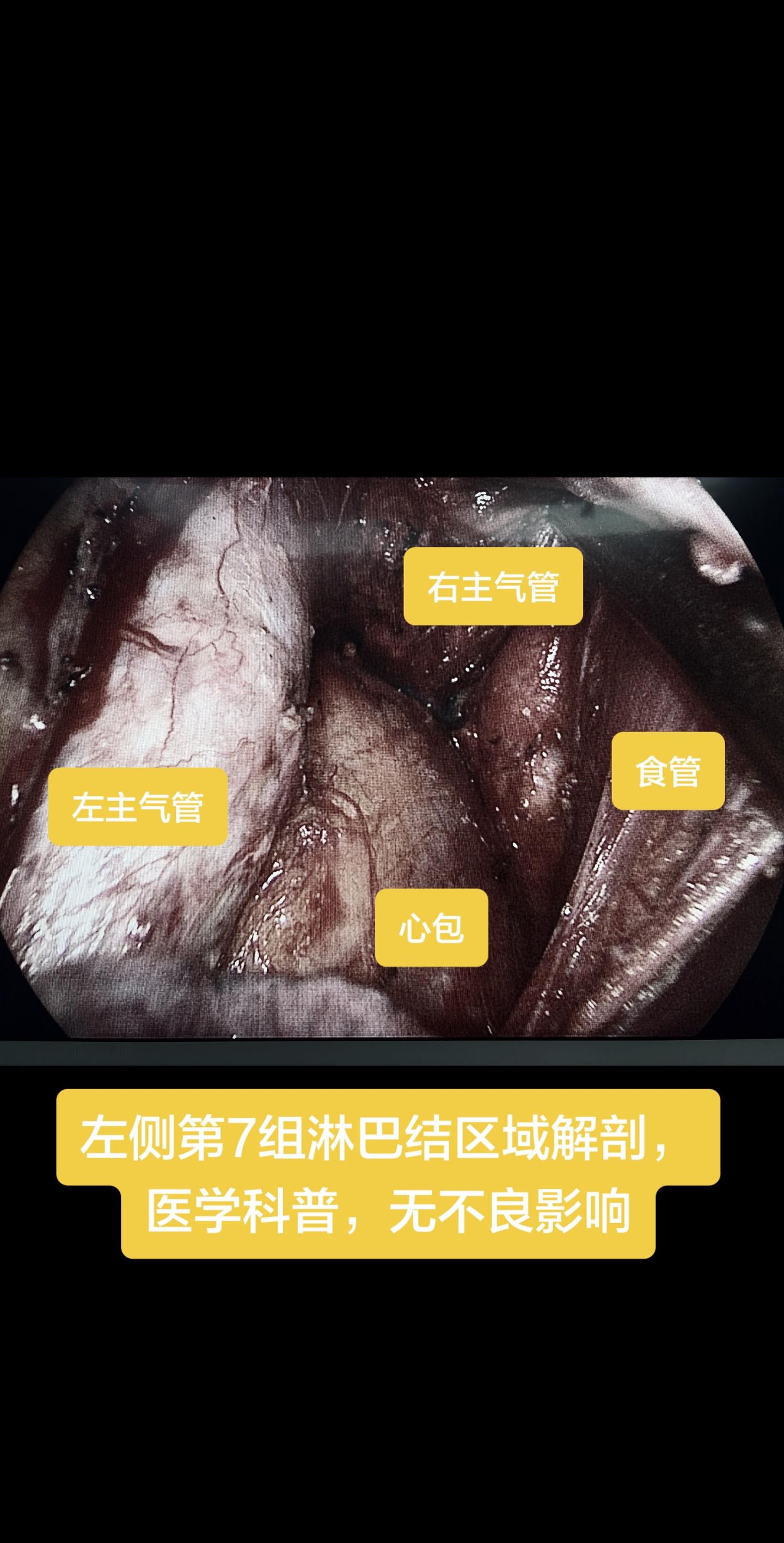 左侧第7组淋巴结区域解剖，医学科普，无不良影响……
