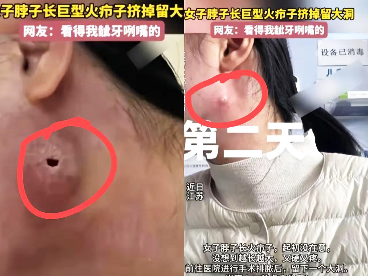 家人们！

江苏姑娘挤火疖子

挤出水泡还留大洞的事儿
看完真的浑身一紧！谁能想