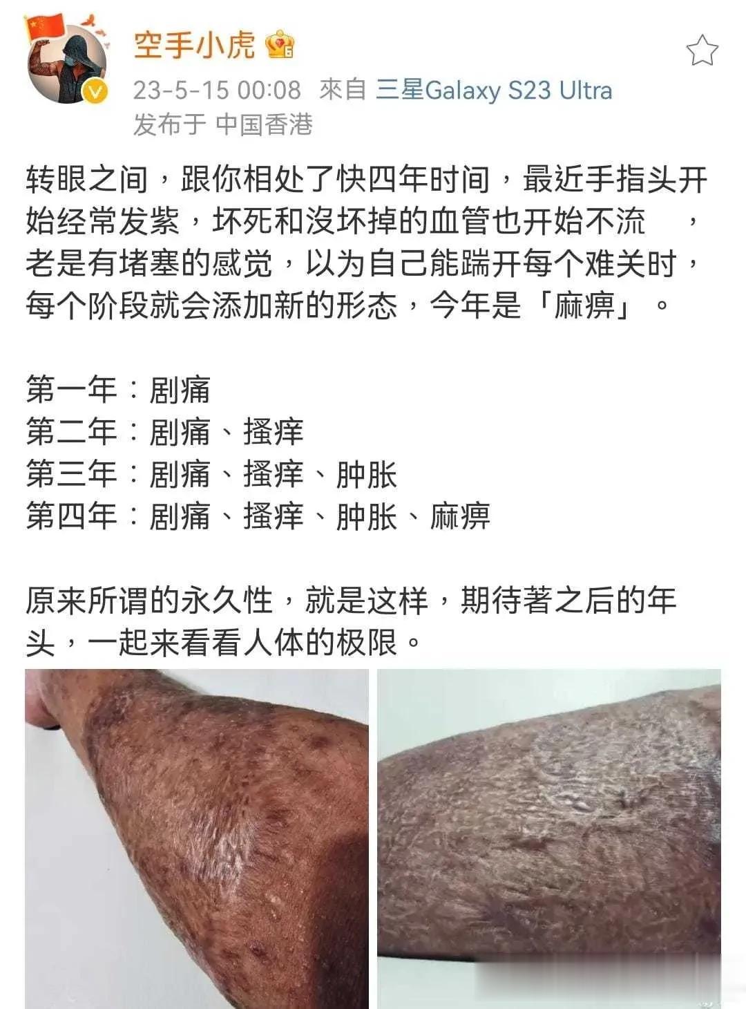 可怕，这名香港警察手上曾被暴徒泼了硫酸，受到这样的伤害真的很不幸。
致敬挡在黑暴