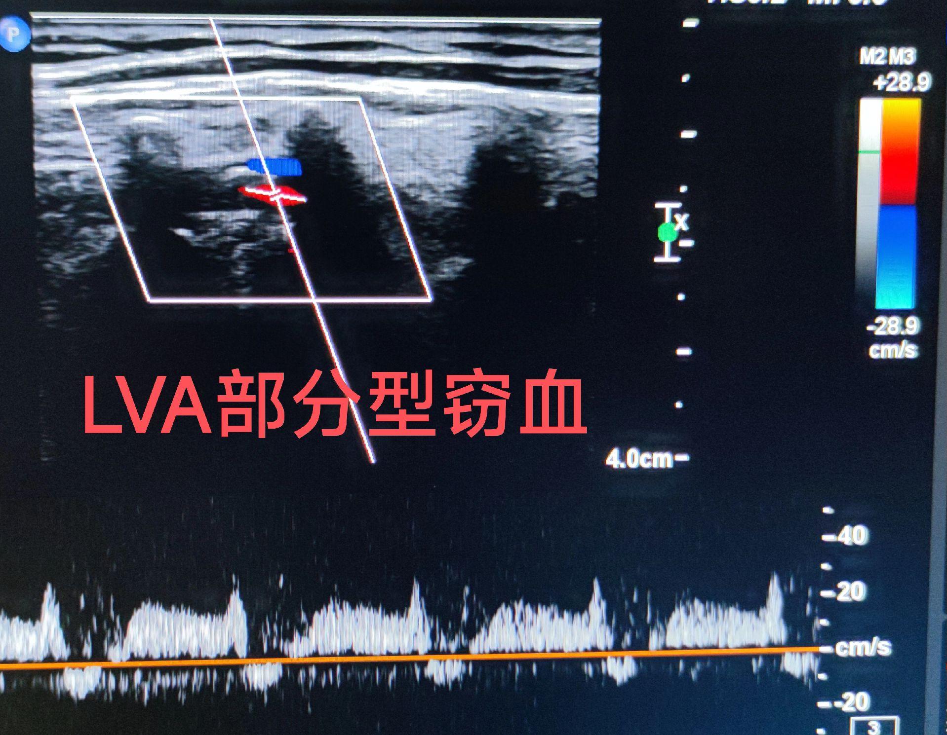 部分型窃血。左椎动脉部分型窃血，收缩期血流方向逆转 左侧锁骨下动脉起始...