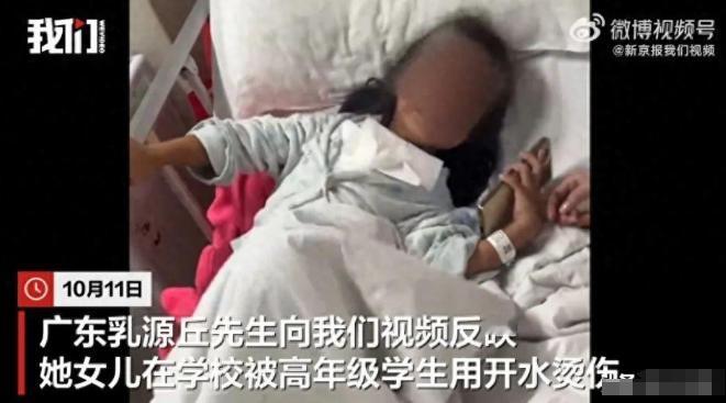 “恶魔”不配被原谅，6岁女童遭高年级学生泼开水烫伤 校方隐瞒真相引发公愤[微风]