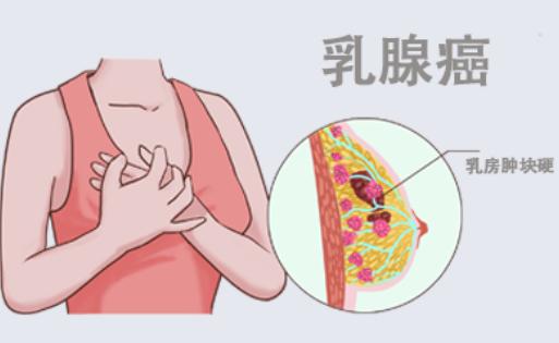 我研究生刚刚毕业，没敢和父母说，我查出了乳腺癌，大概一周多一千，查出来之前偶尔感