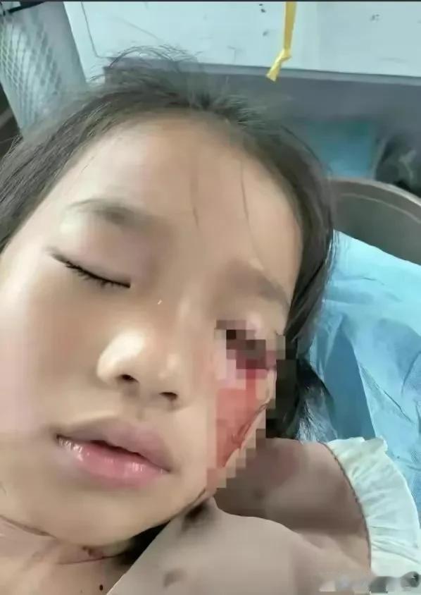 女童被男孩射瞎左眼，警方竟不予立案……

可怕的暑假！江苏沭阳县发生了一起令人心