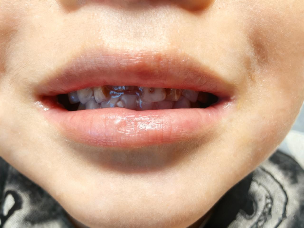 现在孩子的牙齿成了大问题了！

看到过好多孩子的牙齿都成了这个“惨不忍睹”的模样