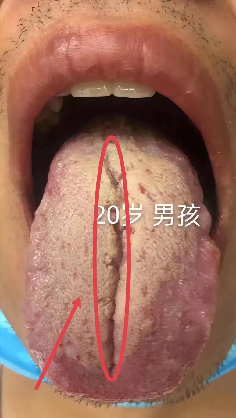 舌头上有一条裂纹和线，如果你是这样的舌头，有的人是肾精亏耗，有的人脾胃虚弱，这个
