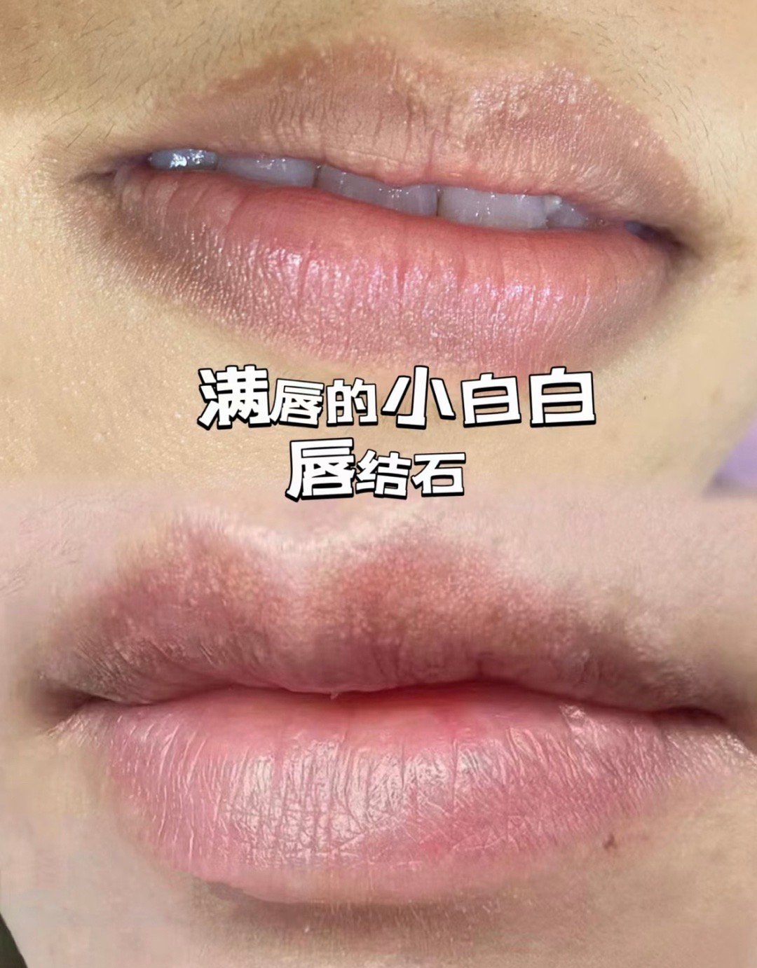 原来这些叫唇结石，你有吗？ ​​​
