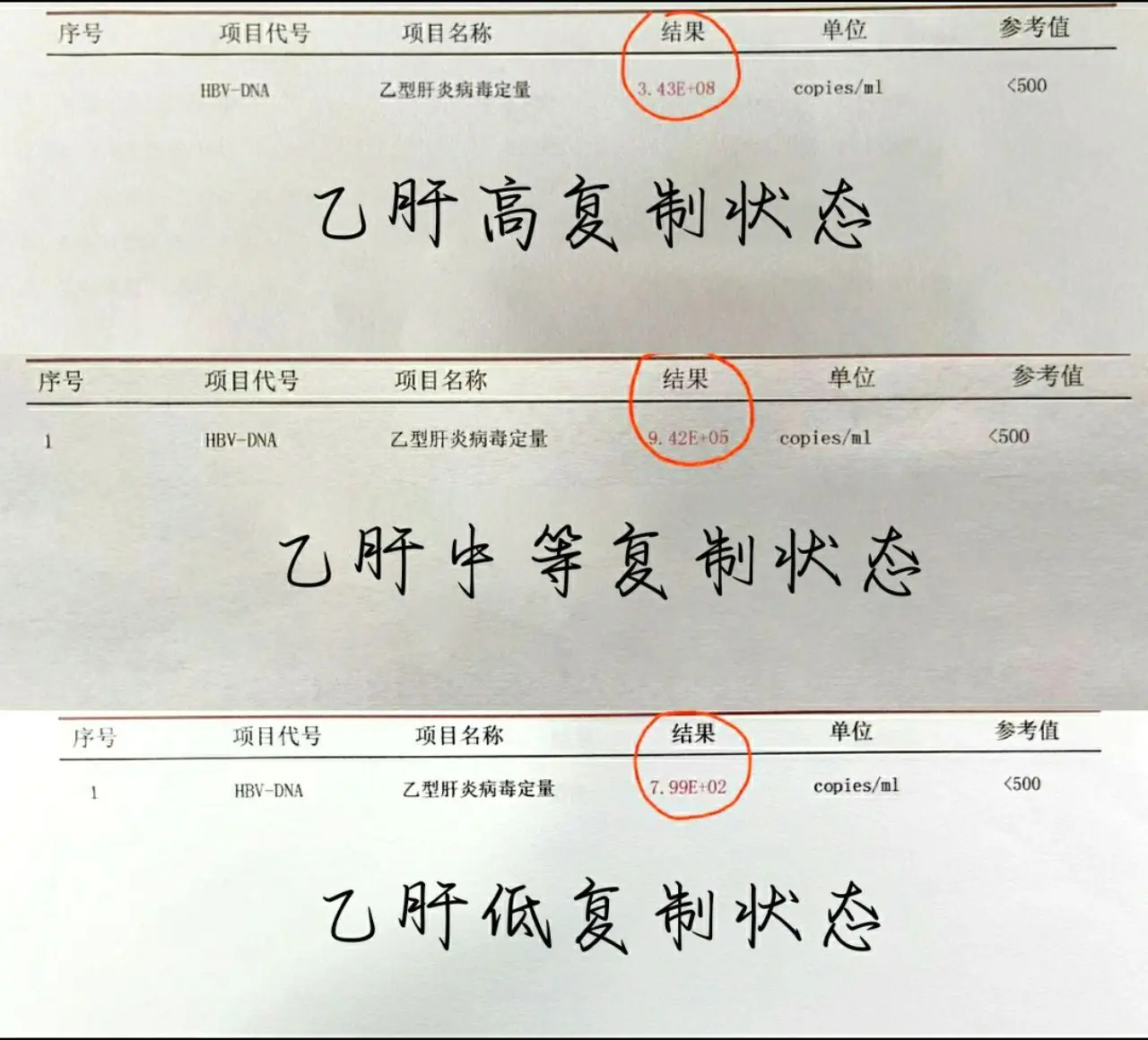 乙肝病毒量多高有危险？ 乙肝病毒量划分大致可分3个等级：1、高复制状态...