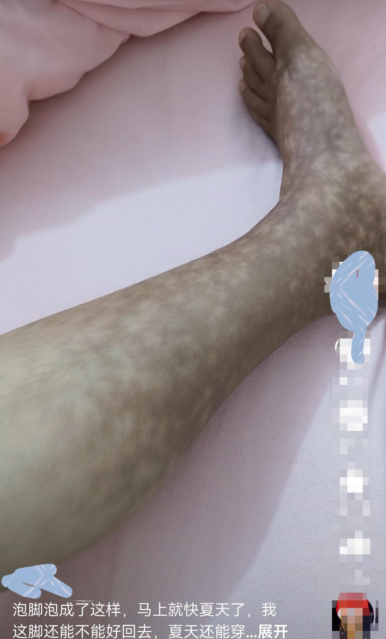 这人是真狠啊，泡个脚直接给自己烫成“血肠”了！
    广西，一名33岁的女子，