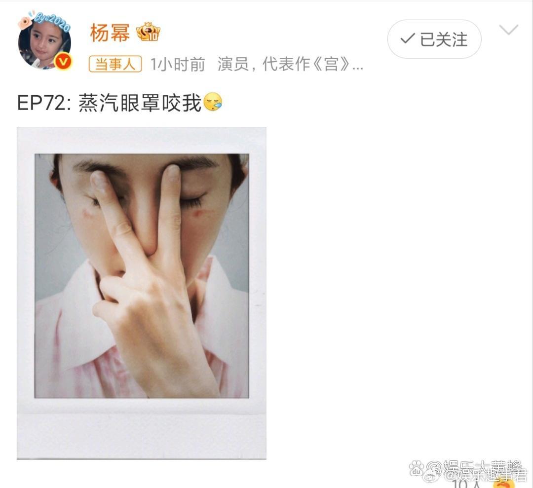 杨幂脸被蒸汽眼罩烫伤了4月27日，杨幂发文透露脸被蒸汽眼罩烫伤了，并晒出照片，面