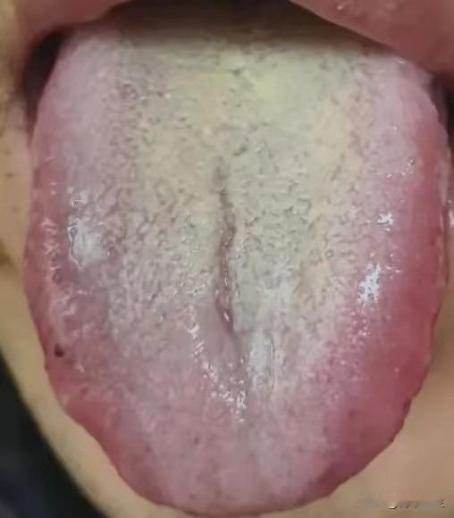 这样的黄腻苔就别去清湿热了，根本不是一回事，病根在肾上，有这样舌象的朋友们，注意