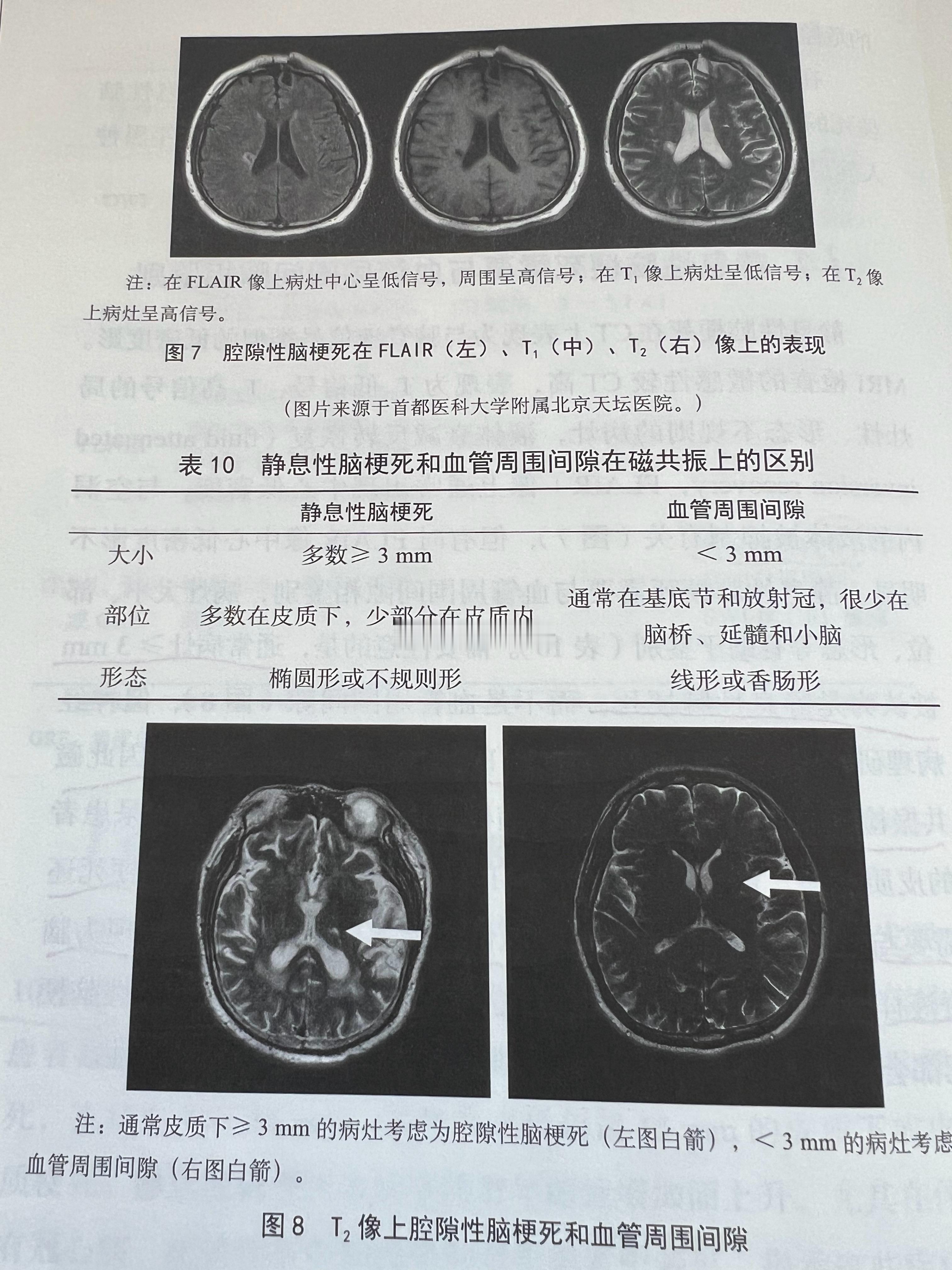 临床上每检查出来1个症状性卒中患者，就会发现10个静息性脑梗死患者，至少90％的