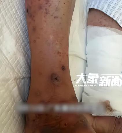 悲剧还是发生了！9月13日广东肇庆，一74岁老人喂鸡时，不慎被鸡给啄了一口，起初