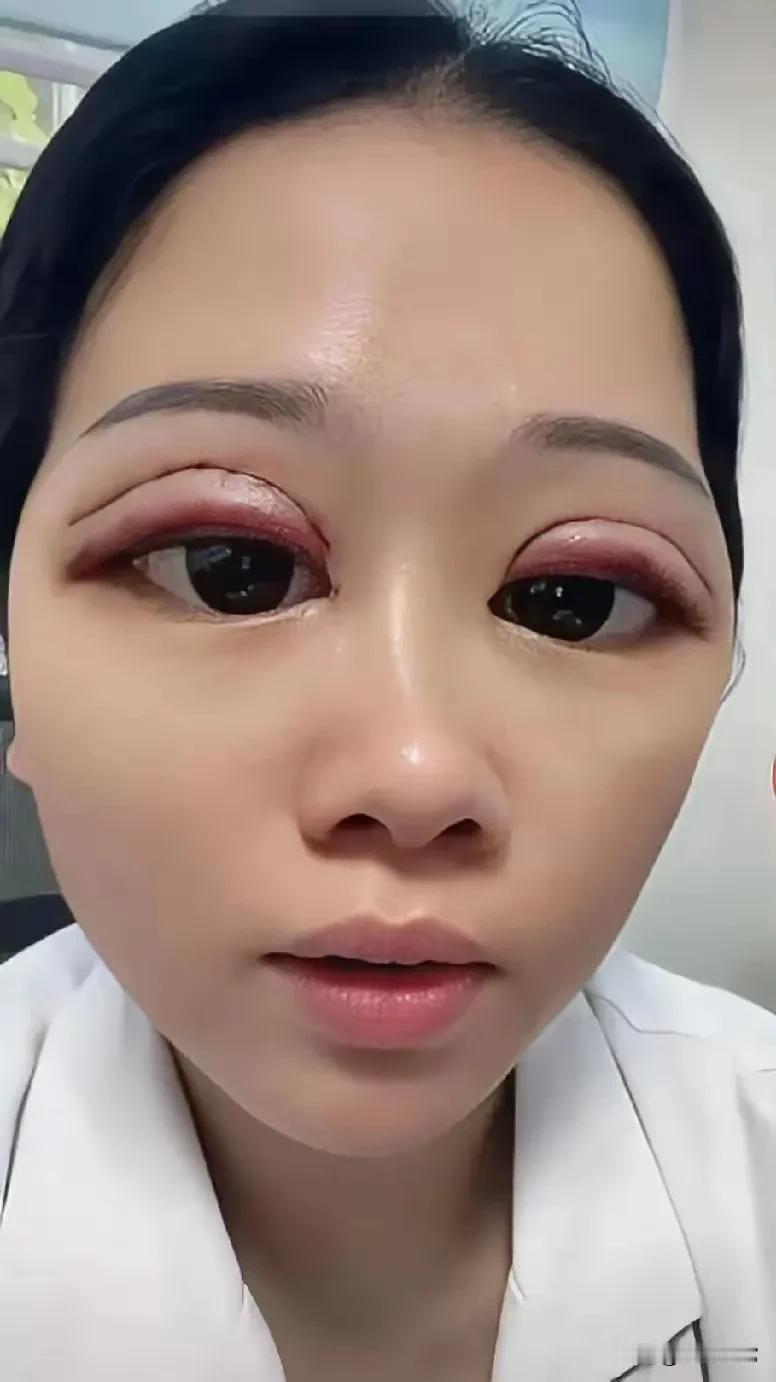 哎呀，这个眼皮好看！主要就是太明显了，在一里之外都可以看到一双眼皮了。这对双眼皮