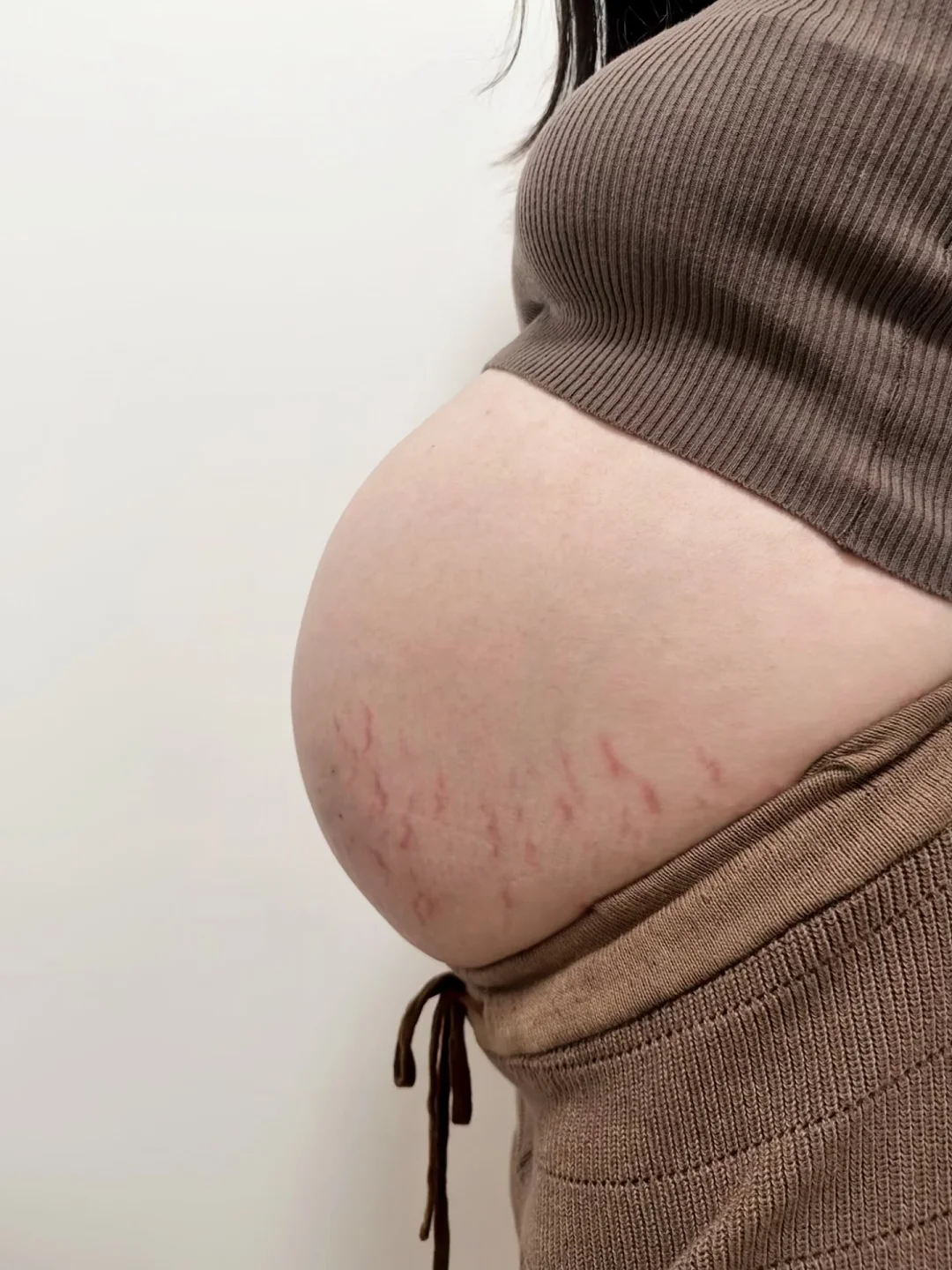 从摆烂到真香！二胎长纹焦虑被它治好了