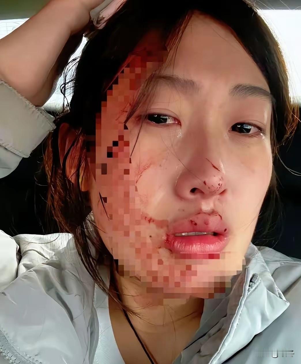 当针尖遇上拳头：一记重拳打碎的不仅是医护的尊严  

冰冷的输液室里，23岁的护