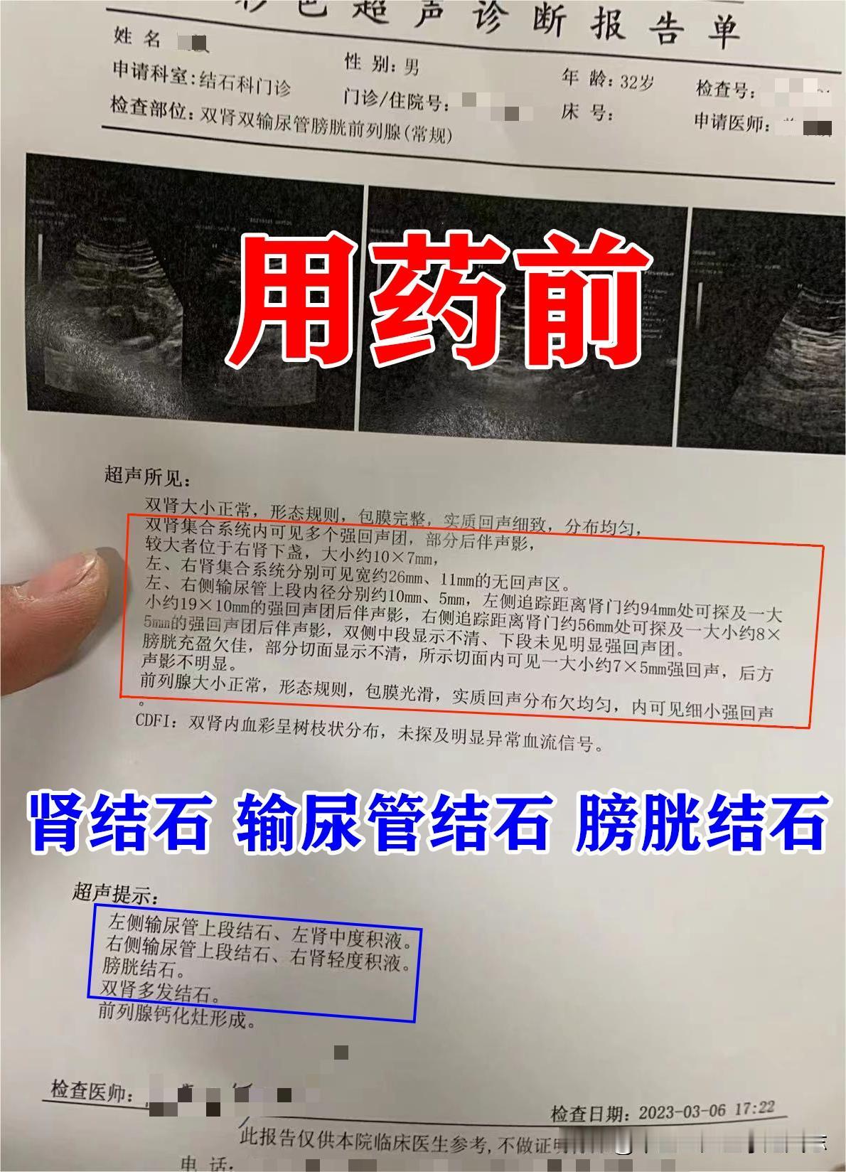 今天这位患者这几处都有结石，大家看一看检验报告单，双肾多发结石，右侧较大，大小约