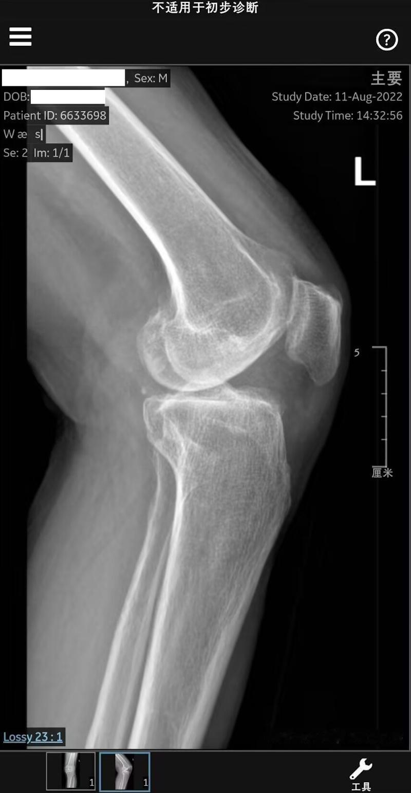 做这个膝关节置换手术的人估计很多，从门诊到现在我们等10天了，还没有接到积水潭医