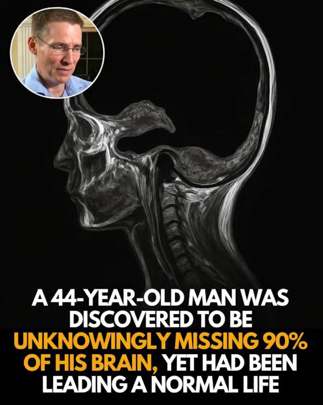 这是一张令人震惊的脑部CT扫描图：一名男子因左腿无力就医，结果发现脑内大部分区域