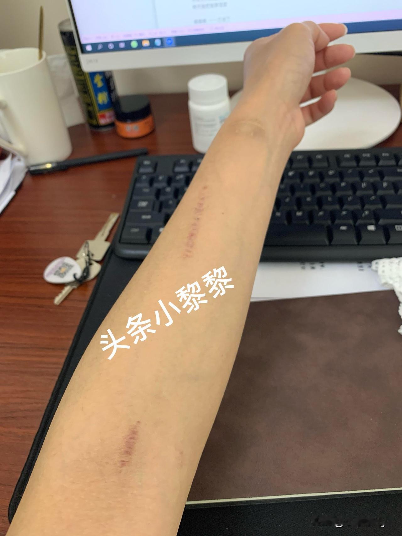 我今天又看到了我透析时的手（图一）又瘦又黄瘘还鼓包，整体还是挺漂亮的，现在的（图