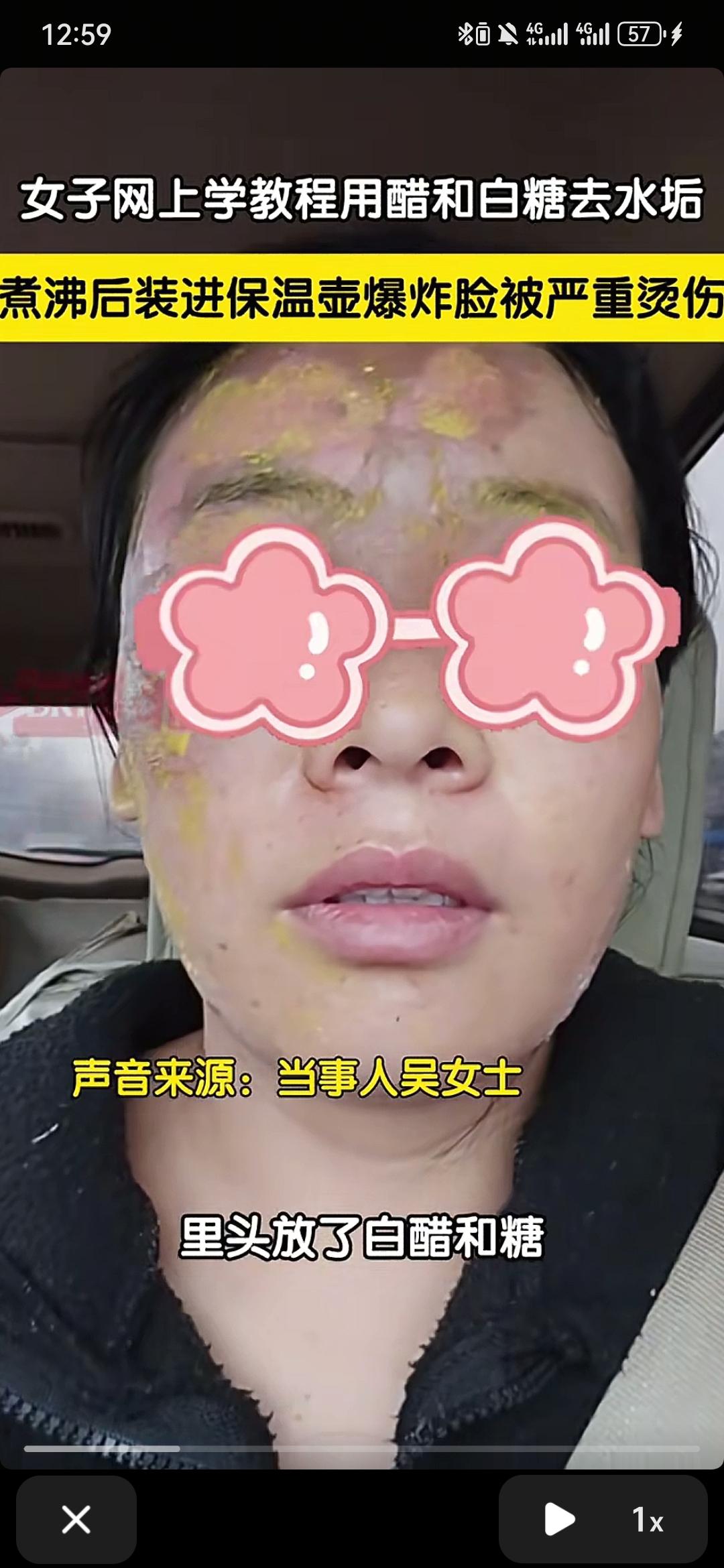 女子学网上“去水垢”教程
不慎爆炸，脸部烫伤
河北一女子因为水壶里面有水垢，于是