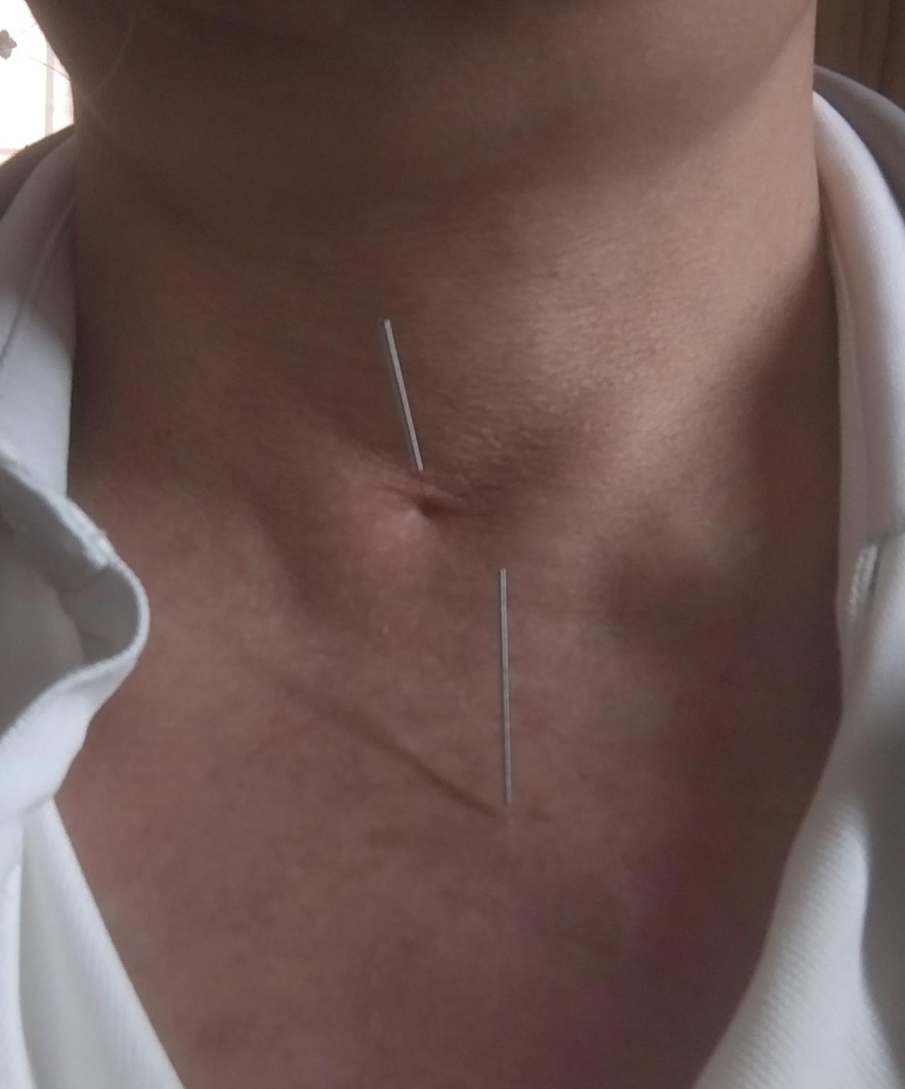 从照片上看，上下两针并不在一条线上，是失误还是有意为之？