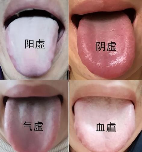 中医教你一分钟学会，分辨身体气虚、血虚、阴虚、阳虚！

1、气虚
表现：提不起精