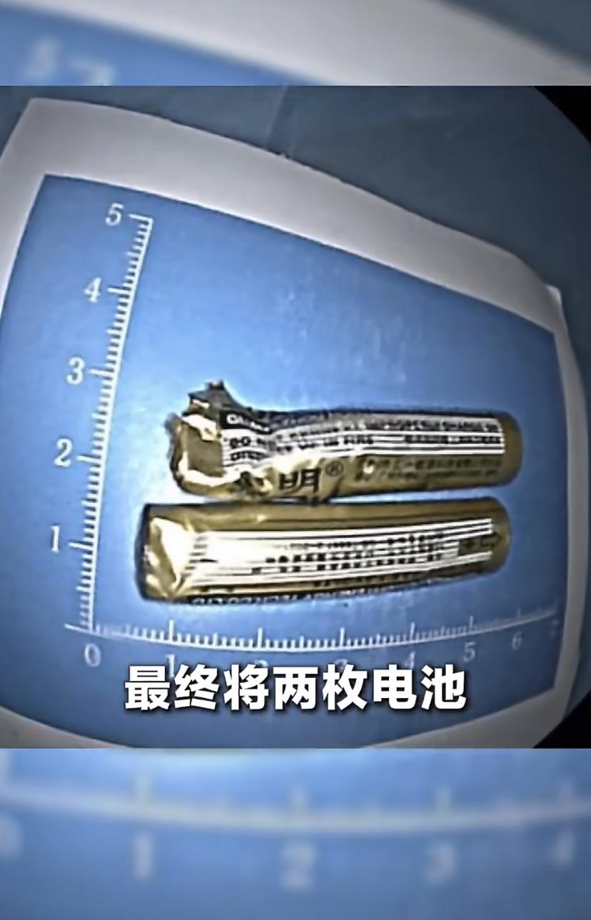 吓人!广州一个少年不知道咋想的，把两节电池咬破后吞进了肚子。家长吓得连夜送医，可