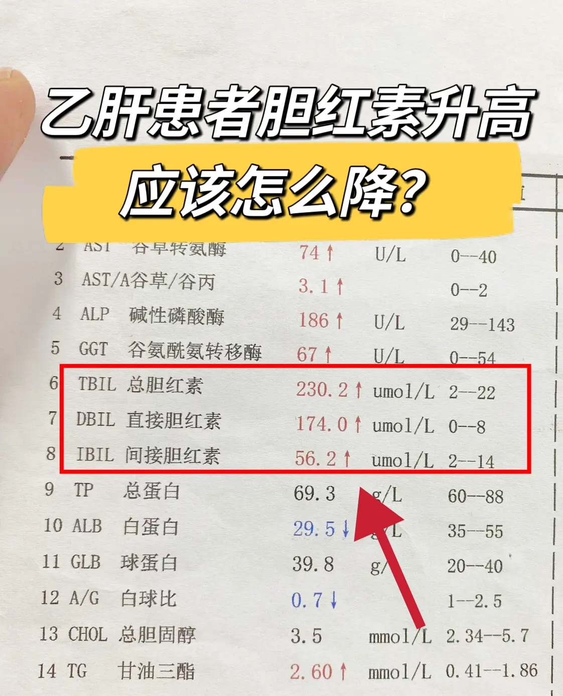 肝功能化验单上胆红素升高怎么降。首先得分情况来说，胆红素分直胆、间胆！...