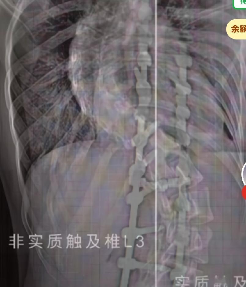 广州18岁女孩脊柱弯曲成s形，因身体呈s型，长期自卑，拒绝社交，
她在医院接受高