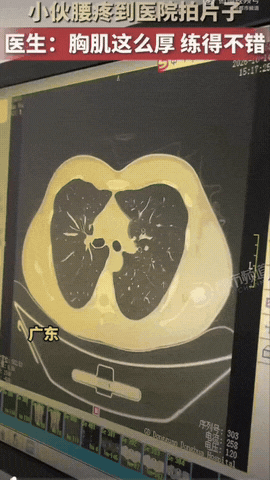 广东一名男子腰疼去医院拍片，本来是想查查腰的问题，结果胸片一出，医生看完实在忍不