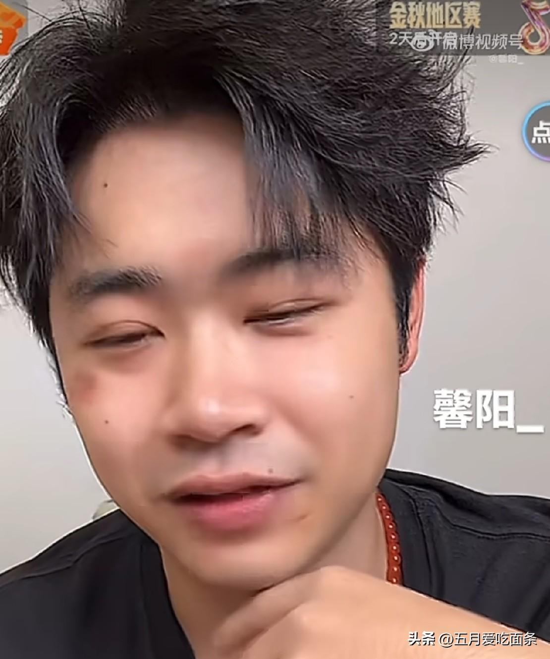 曹巍脸受伤了，颧骨和右眼袋好像都被打伤了，双眼皮都不一样了。
封训刚结束，曹巍就