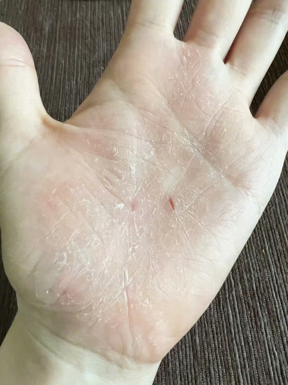 张靓颖一伸懒腰手掌就流血这是干的吧！干裂，才会有这种小口子[无聊][无聊] ​​