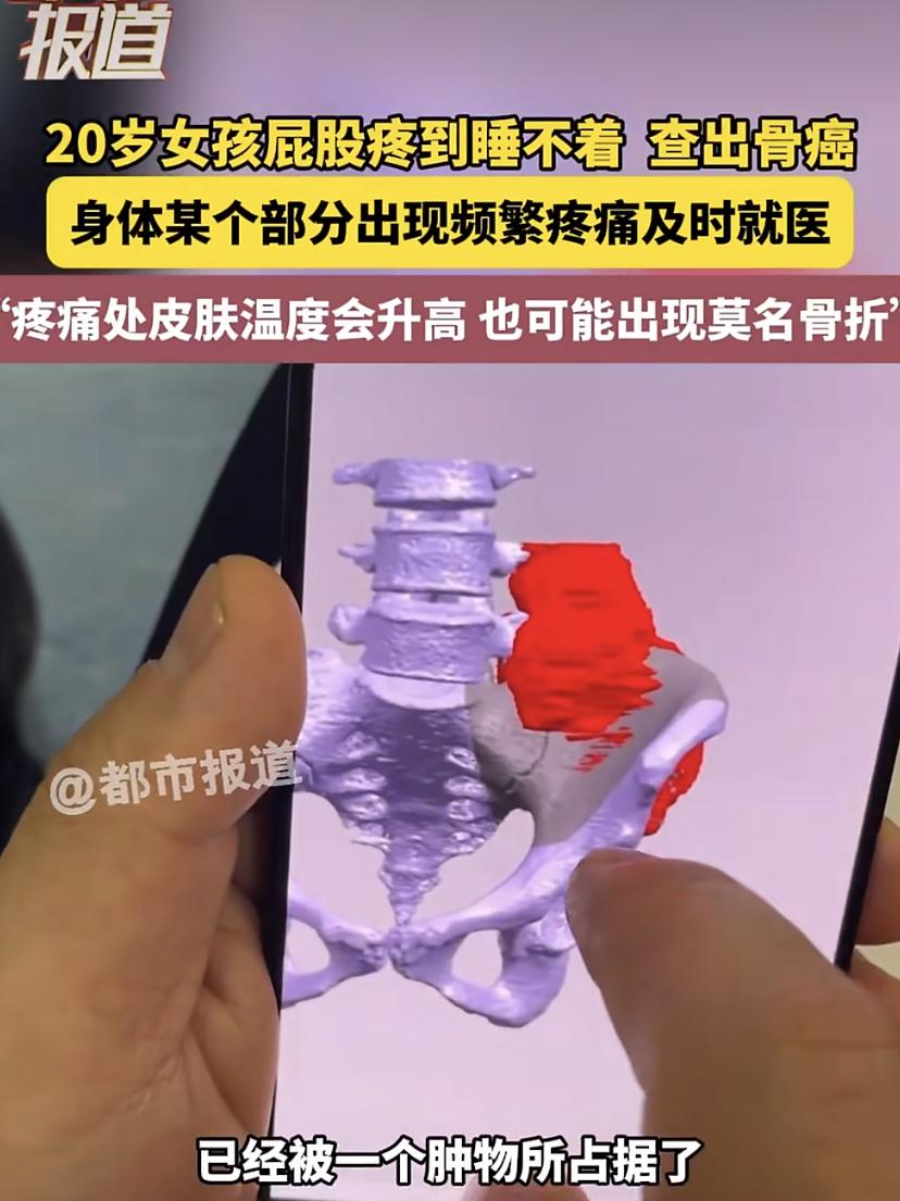 在河南，一位20岁的姑娘经历了长达8个月的"怪事"：左边屁股总是隐隐作痛。她没太