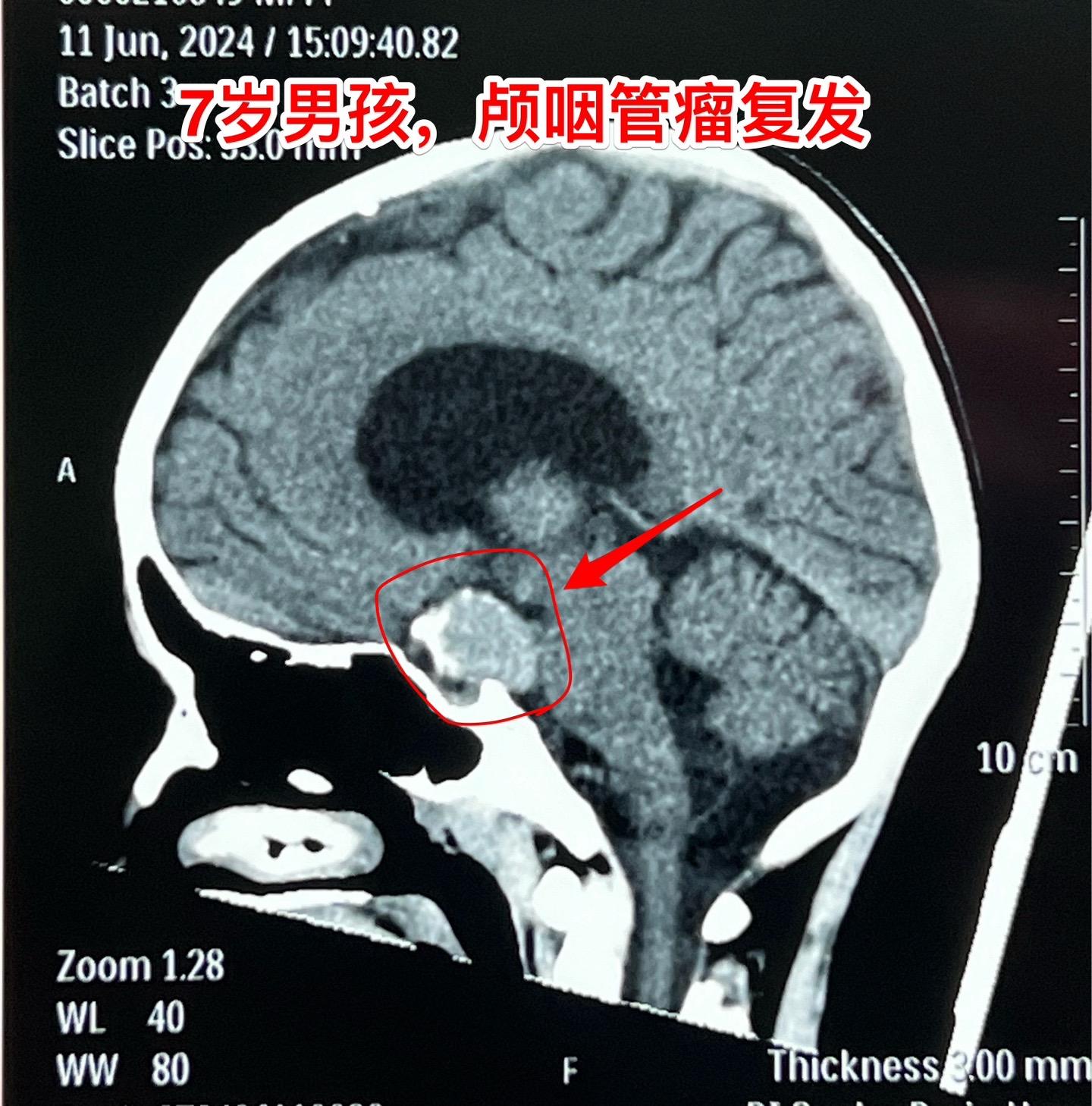百日咳导致患儿颅咽管瘤手术推迟了三个月。7岁 男孩子三个月前因颅咽管瘤...