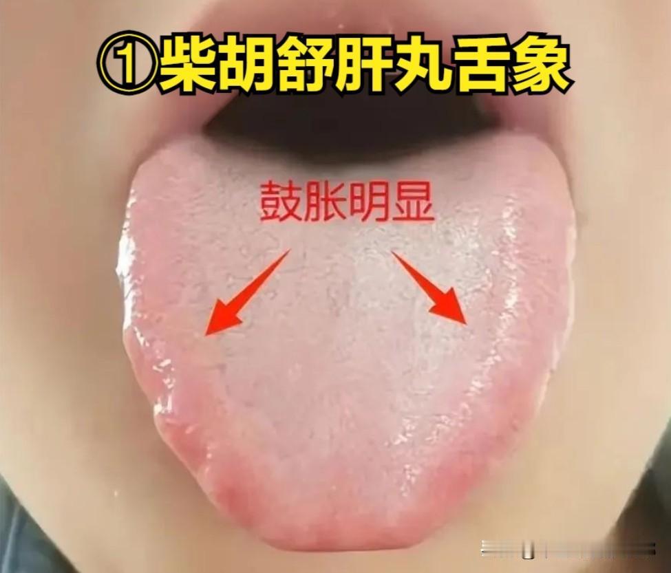 百病不离郁，肝郁从轻到重，4大阶段4种舌象，你属于哪一种

1、肝郁气滞
舌象：