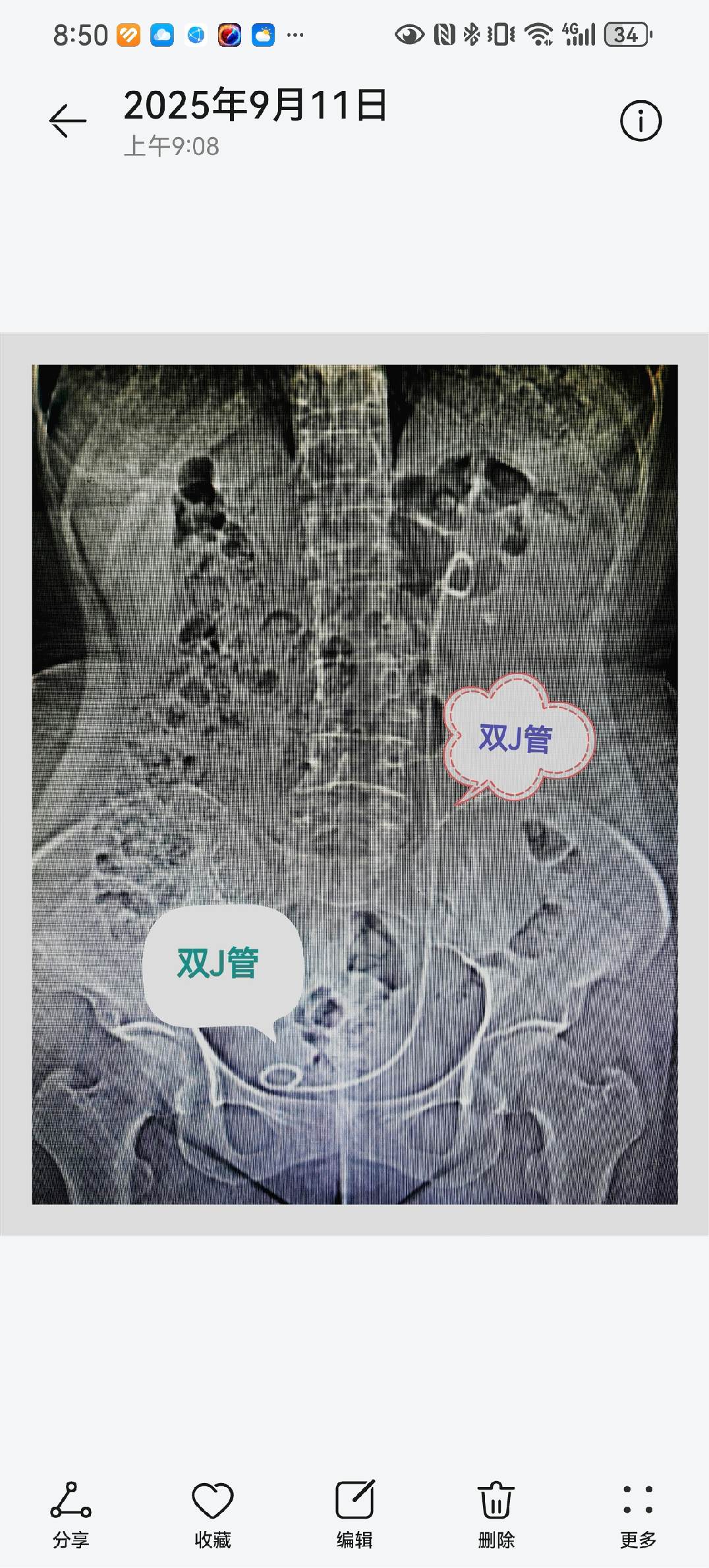 关于双J管。双J管：身体里的“临时下水道” 术后放在体内，连接肾和膀胱...