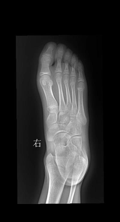 足外伤 14岁 女 第一跖骨软组织肿胀