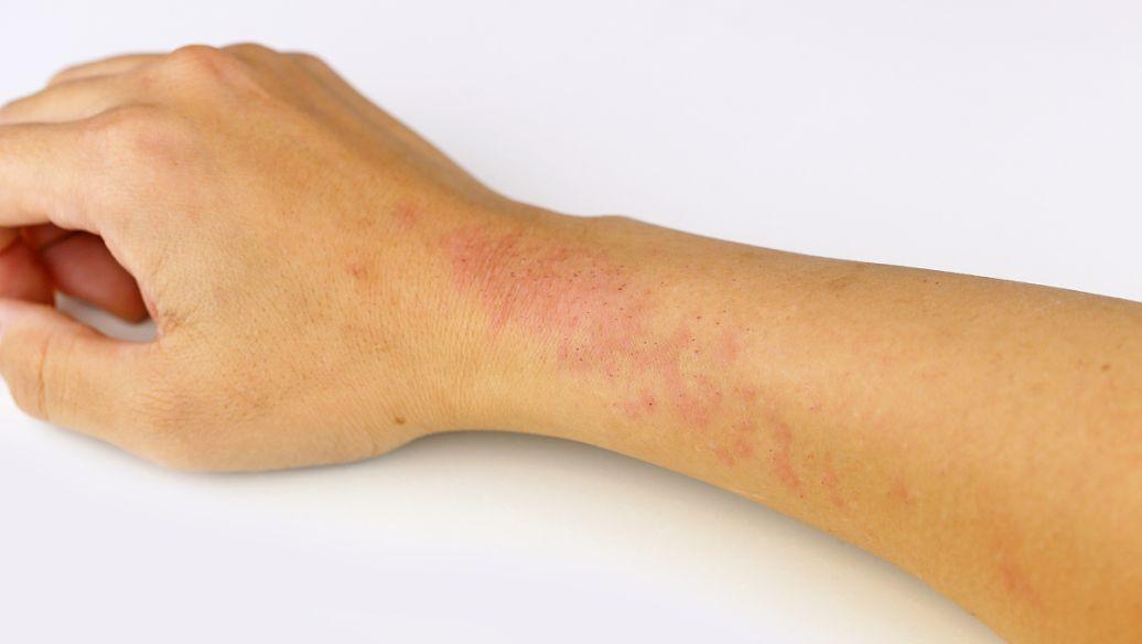 身上突然冒出来的小红点是什么？2种可能是癌症先兆，别不当回事

皮肤上突然冒出几