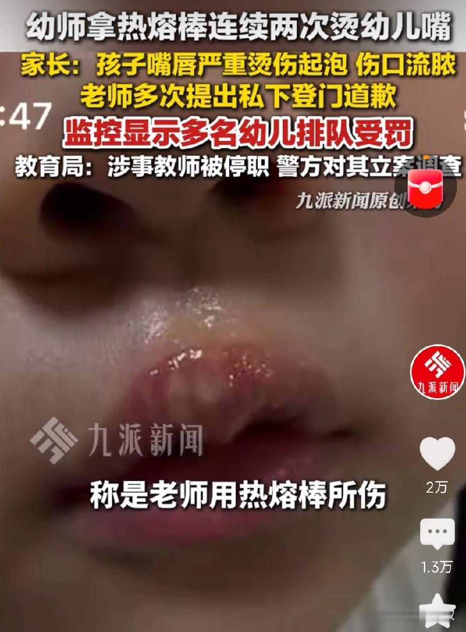 江苏丰县那个幼儿园拿胶枪汤小朋友嘴的老师：
一，够狠，小朋友都下的去手。
二，家