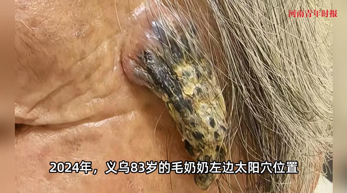 “活久见！”浙江义乌，一位83岁的老太因为经常出门晒太阳，结果在左边太阳穴的位置